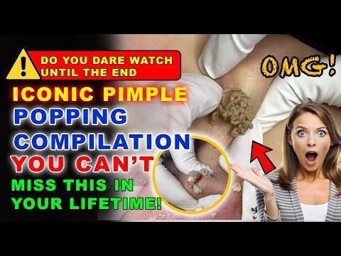 The Ultimate Compilation of Legendary Pimple Popping – A Must-Watch Before You Die!