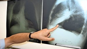 Weltweit steigt die Zahl der Krebsdiagnosen: Etwa jeder Fünfte erkrankt im Leben daran