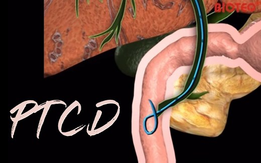经皮肝穿刺胆道引流术（PTCD）