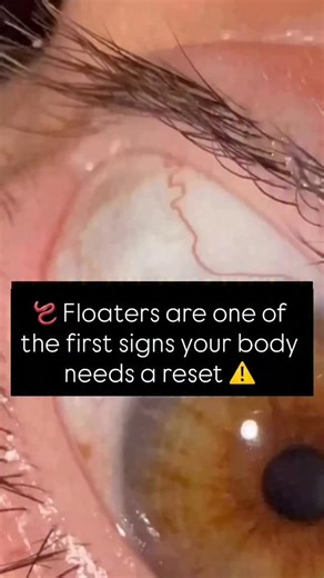 Danica on Instagram: "Let’s talk about eye floaters — and why they’re worth paying attention to. Most people are told floaters are “normal” or “just aging”… but they can also be a sign your body is dealing with inflammation, toxicity, or internal stress that shouldn’t be ignored. Here’s what’s really going on: Those drifting specks, threads, or shadowy “worms” you see are often your eyes reacting to oxidative stress, toxin buildup, or imbalances in the body’s terrain — the same conditions where 