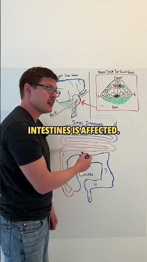 IBS Causes Revealed: Dr. Hamer’s Discovery