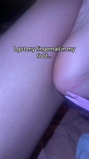 Effective Methods for Splinter Removal at Home