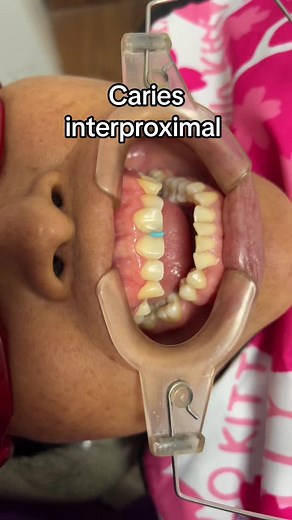 Caries interproximal , sucede cuando no usamos el hilo dental y los restos de comida se quedan entre diente y diente formando esto 😭🥹🦷 #dientes #dientesblancos #dientesperfectos #cariesdental #sarrodental #limpiezadental #dentistaentiktok #dentista #viralvideo #sanjuandemiraflores #villaelsalvador #villamariadeltriunfo #sangabriel #surco #santaanita