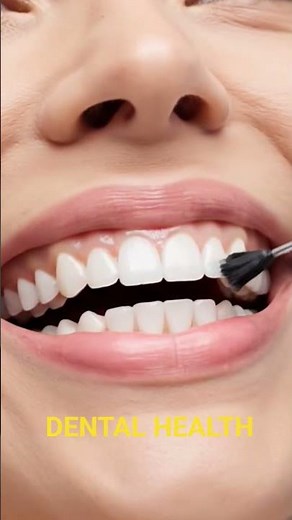✨ 3D Dental Animation | Bonding Orthodontic Braces Step by Step