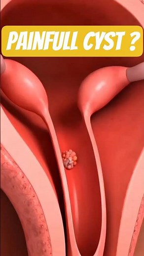 Don’t Ignore This Pain! Bartholin Cyst Explained #cyst #infection #reproductivehealth