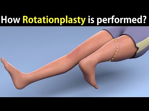 What happens in Rotationplasty?