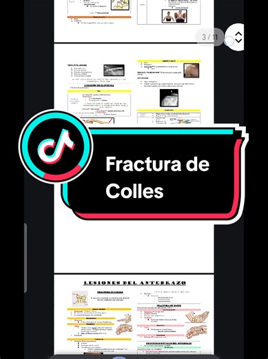 🦴 Fractura de Colles 📌 Es una fractura del radio distal que ocurre cuando una persona cae sobre la palma de la mano con la muñeca en dorsiflexión (mano extendida). 📌 La parte distal del radio se desplaza hacia atrás (dorsal), produciendo la clásica deformidad en “dorso de tenedor”. 📌 Característica importante: ✔️ Generalmente no compromete la superficie articular del radio (es extraarticular). 📌 ¿En quién es más frecuente? 👵 Adultos mayores, especialmente con osteoporosis. 📌 Ejemplo fácil