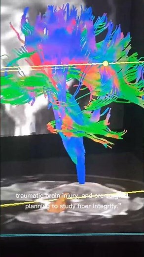 MRIi DTI Diffusion Tensor Imaging #mri #anatomy #pathology mri fiber maping