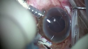 Repeat IOL Dislocation - Eyetube