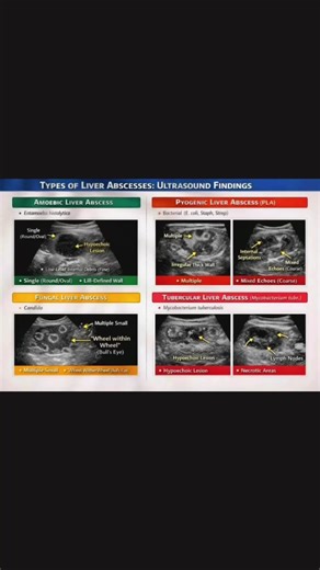1. Pyogenic Liver Abscess (Bacterial) – US Features Most common type 🔹 Appearance Hypoechoic or complex cystic mass Thick, irregular echogenic wall Internal low-level echoes (pus/debris) May show septations Gas → echogenic foci with dirty acoustic shadowing 🔹 Doppler Peripheral hyperemia No internal vascularity 🔹 Number Single or multiple 2. Amoebic Liver Abscess – US Features Classically solitary 🔹 Appearance Round or oval hypoechoic lesion Homogeneous low-level internal echoes Thin, smooth