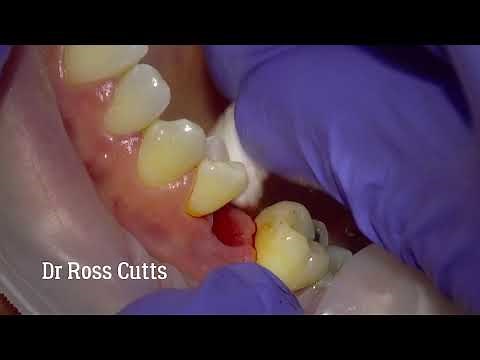 Fitting an Implant Screw retained crown