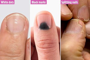 From arthritis to anaemia... what your fingernails say about your health
