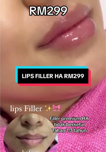 Lips Filler Premium HA di Setapak