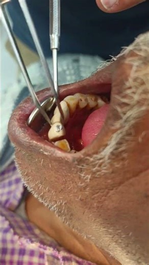 Loose Teeth Warning ⚠️ Causes & Treatment | Save Your Natural Teeth