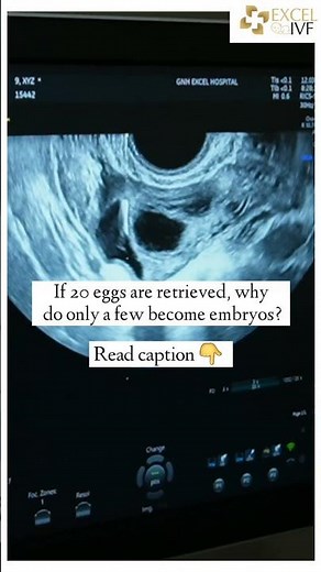 IVF Facts: Understanding Egg Quality, Fertilization & Blastocyst Development | Dr Rhythm Gupta