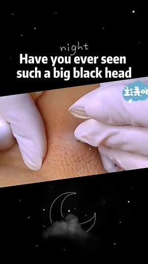 #blackhead #foryoupage #funnyvideo #funnymoments #asmr #fypシ #foryou #foryourpage