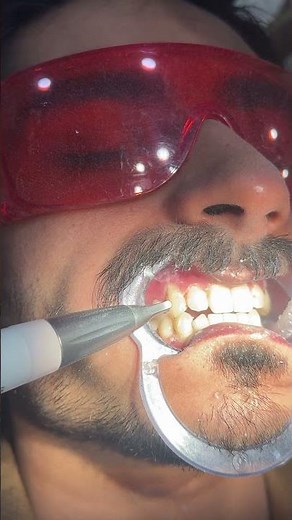 🔥 NEW Teeth Cleaning Method Dentists Recommend 🦷 Remove Plaque & Stains Fast!