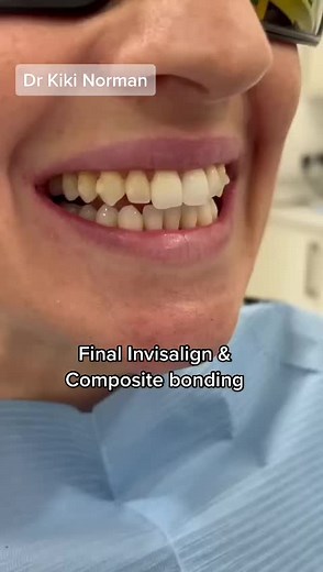 Final Invisalign Result & Composite Bonding Transformation