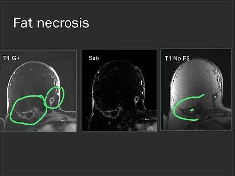 Breast MRI - common findings and cases