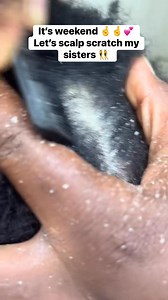 It’s a beautiful weekend Let's scalp scratch #scalppsoriasis #scalpscratchingasmr #psoriasis #dandruff | Meneawara Precious Barilunanee
