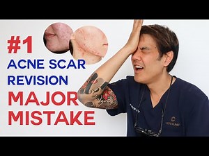 What to consider BEFORE acne scar revision| Dermatologist Guide