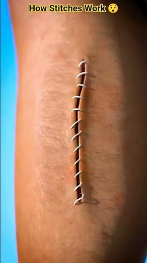 How Stitches Work 😯