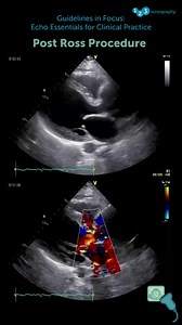 Aortic root dilatation is a well-documented late complication after the Ross procedure. While the autograft offers excellent long-term benefits, its dilatation over time can lead to progressive aortic regurgitation, necessitating regular echocardiographic surveillance and, in some cases, reoperation. This is a critical aspect of post-Ross patient management. Get our Guidelines in Focus course now for a special discount 👉 https://zurl.co/Qg55f #EchoEssentials #EchoGuidelines #LatestGuidelines #G