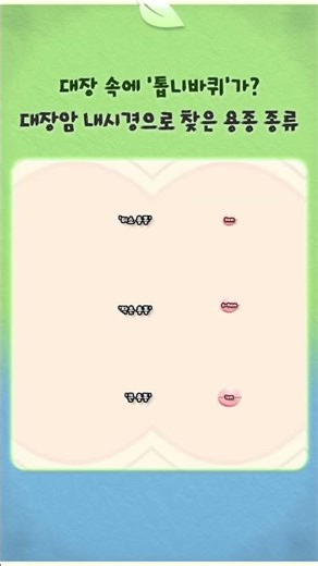 대장 속에 ‘톱니바퀴’가? 대장암 내시경으로 찾은 용종 종류