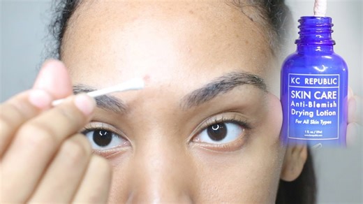 How I cleared my forehead breakout overnight | KC Republic drying lotion demo & review