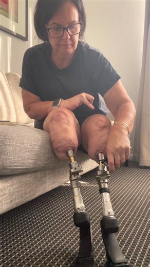 Shower feet to everyday feet, loving these Terra feet #prosthetics #terra #ossur #amputee #osseointegration @Össur @Osseointegrationgroup @Prof.Al.Muderis