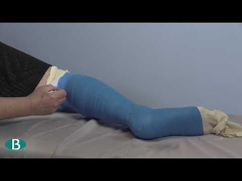 Sarmiento FRC (Benecast Advanced Casting Tape)