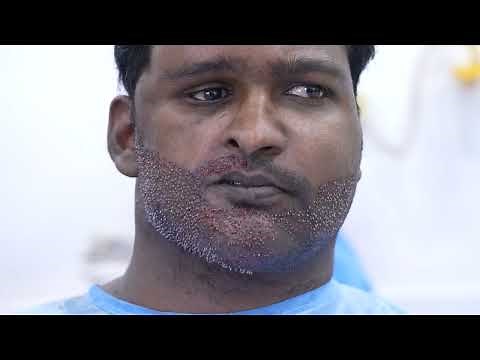Moustache Beard Transplant Surgery | Complete Process | Before & After Results