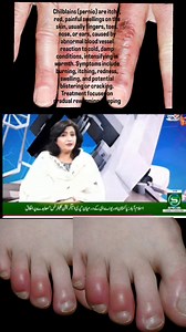 Chilblains (pernio) are itchy, red, painful swellings on the skin, usually fingers, toes, nose, or ears, caused by abnormal blood vessel reaction to cold, damp conditions, intensifying in warmth. Symptoms include burning, itching, redness, swelling, and potential blistering or cracking. Treatment focuses on gradual rewarming, keeping warm and dryسردیوں میں ہا تھ پاؤں کا ٹھنڈا ہو جانا نارمل ہے یا کسی بڑی بیماری کی طرف اشارہ ہے chillies and chilblains Recording of Social Health TV program with Hos