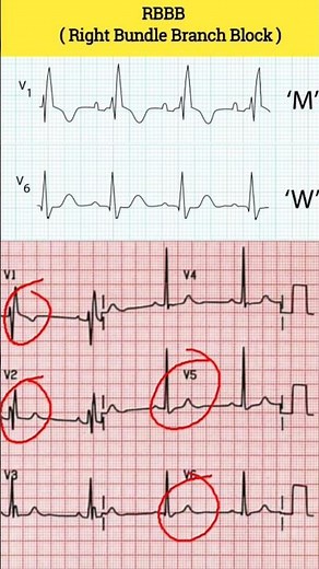 RBBB ( Right Bundle Branch Block ) on ECG : quick explanation #ecg #rbbb #shortvideo