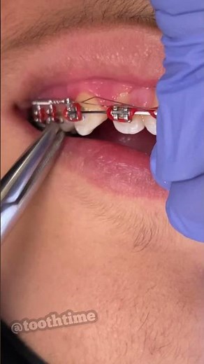 What are coil springs used for on braces? Braces On - Tooth Time Family Dentistry New Braunfels