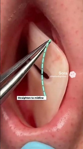 Septoplasty Procedure Explained – Step by Step for Medical Students #shortvideo
