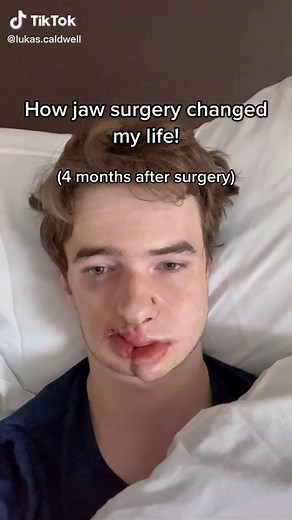 Life After Jaw Surgery: 4 Months Post-Op Transformation