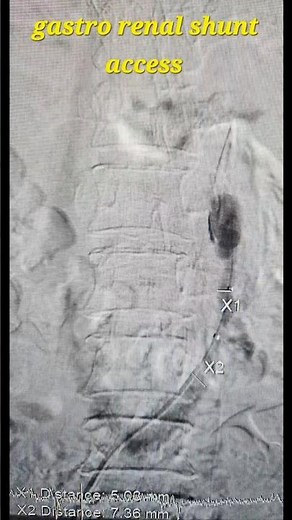 BRTO (Balloon-Occluded Retrograde Transvenous Obliteration) of gastric varices