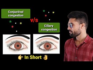 conjuctival congestion, ciliary congestion lecture opthalmology