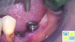 23 reactions | Does the treatment & care of dental implants fill you...