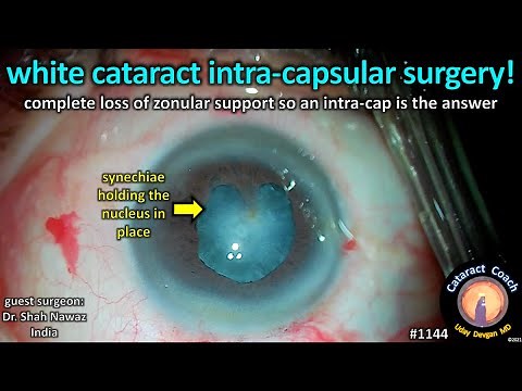 CataractCoach 1144: white intra-capsular cataract extraction surgery