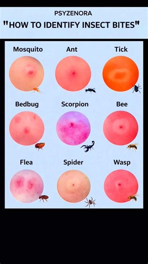 How to Identify Insect Bites?#InsectBites #HealthTips #SkinCare #Awareness #Shorts