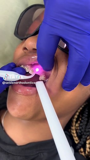 This is a laser exposure of an unerupted tooth. This helps the tooth grow into the mouth! 🦷 #orthodontics #orthdontist #blackorthodontist #doctor #blackdoctors #orthodontistlife #ortholove #oralhealth #uneruptedtooth #tooth #teeth #braceslife #newsmile #seldensmiles #retainer #CLT #northcharlotte #universitycitycharlotte #charlottenc #huntersvillenc #laser #lasers #laserprocedures