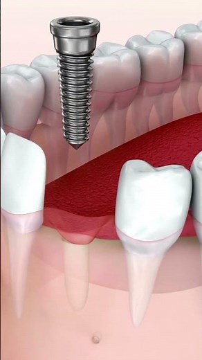 Have You Seen the The Tooth implant installation process