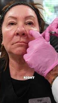 What Is Facial Balancing? Natural Filler Placement Explained