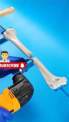 🤔👨‍⚕| How Doctors 👨‍⚕ Fix a Broken Bone | Amazing Bone Repair Process