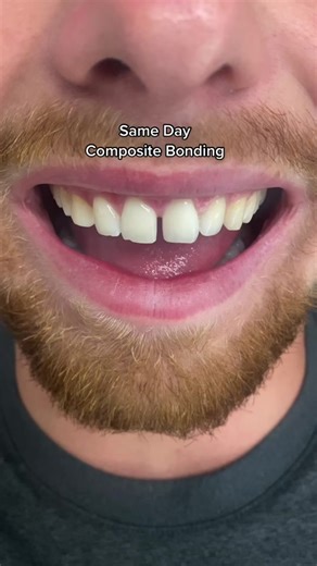 Direct Composite Bonding for Teeth Gap Closure and Even Edges | Dr. Hamzah
