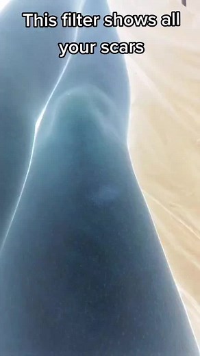 All my work scars. Can you see which is the fresh wound? #scars #workscars #bruises #burns #cuts #scarfilter #filter #mcdonalds #uk #wolf_lass