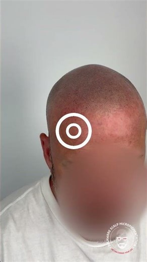 Scalp Micropigmentation Before & After | Bald to Hairline Transformation #hairlosssolution #smp