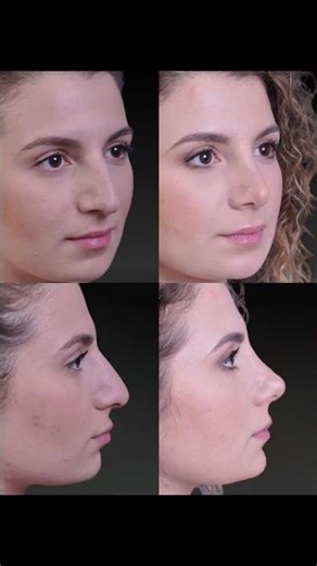 5 months post open-structure rhinoplasty + septoplasty.